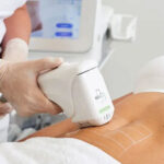 HIFU High-Intensity Focused Ultrasound Body Treatments in Navi Mumbai
