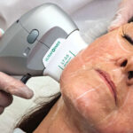 HIFU High-Intensity Focused Ultrasound Skin Treatments in Navi Mumbai