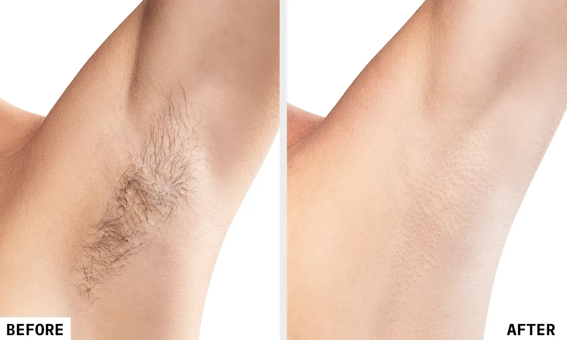 Laser Hair Removal Before and After Result 2