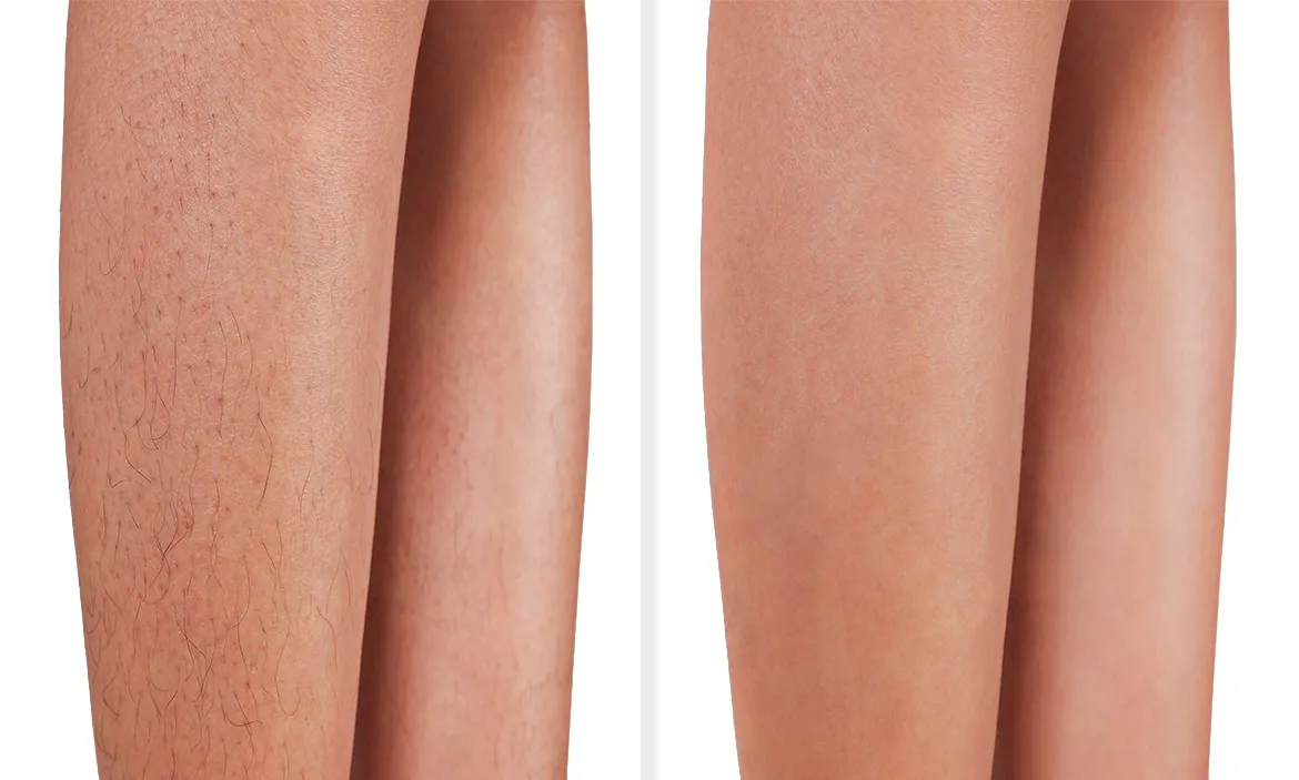 Laser Hair Removal Before and After Result 3