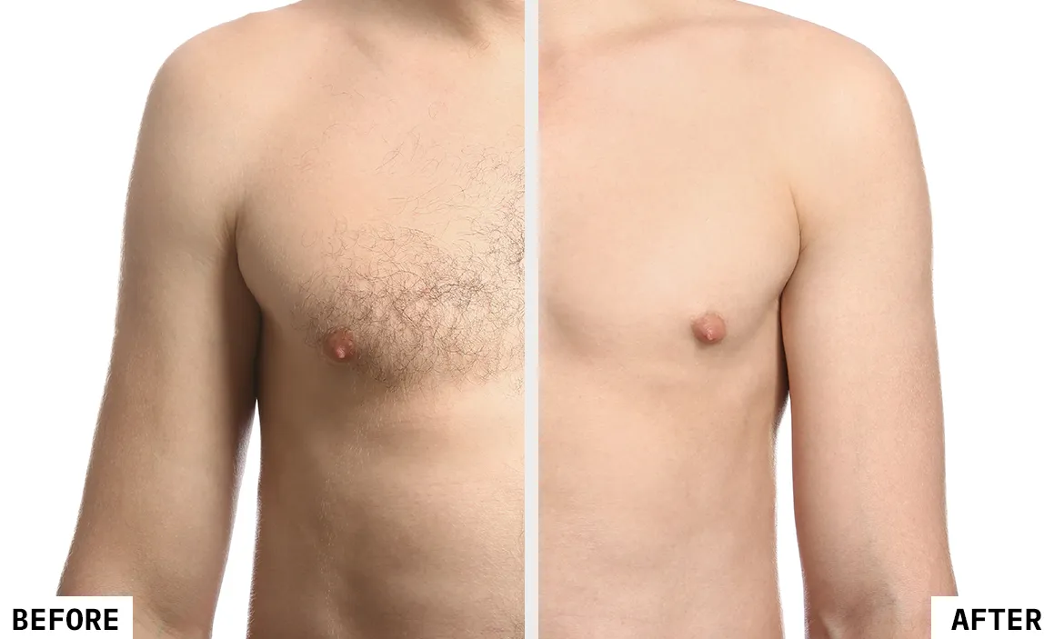 Laser Hair Removal Before and After Result