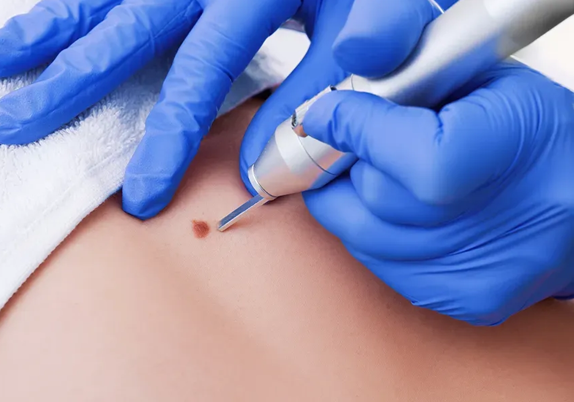 Best Skin Treatment Skin Tag Removal in Navi Mumbai