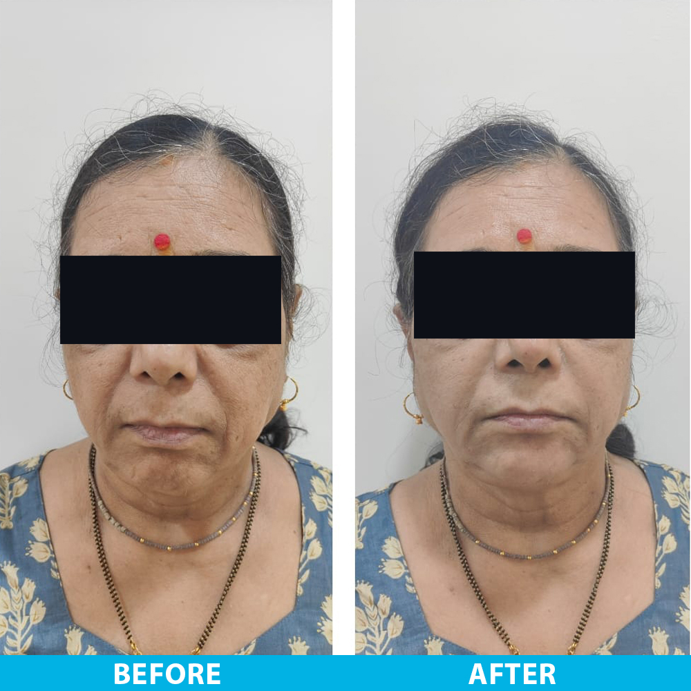 Chin-fillers Exella Clininc 1