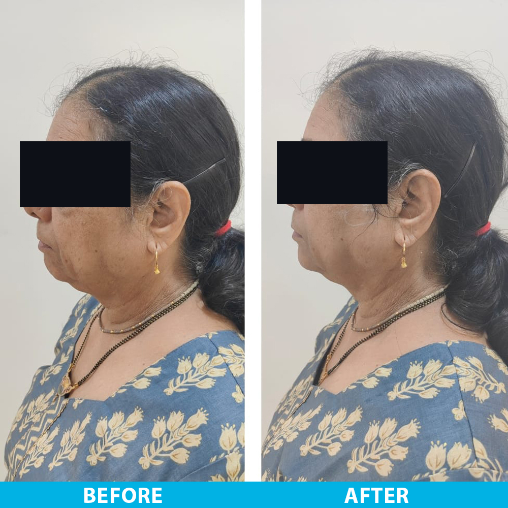 Chin-fillers Exella Clininc 3