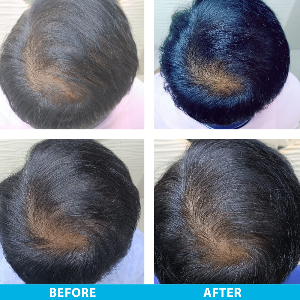 Hair Growth Factor PRP