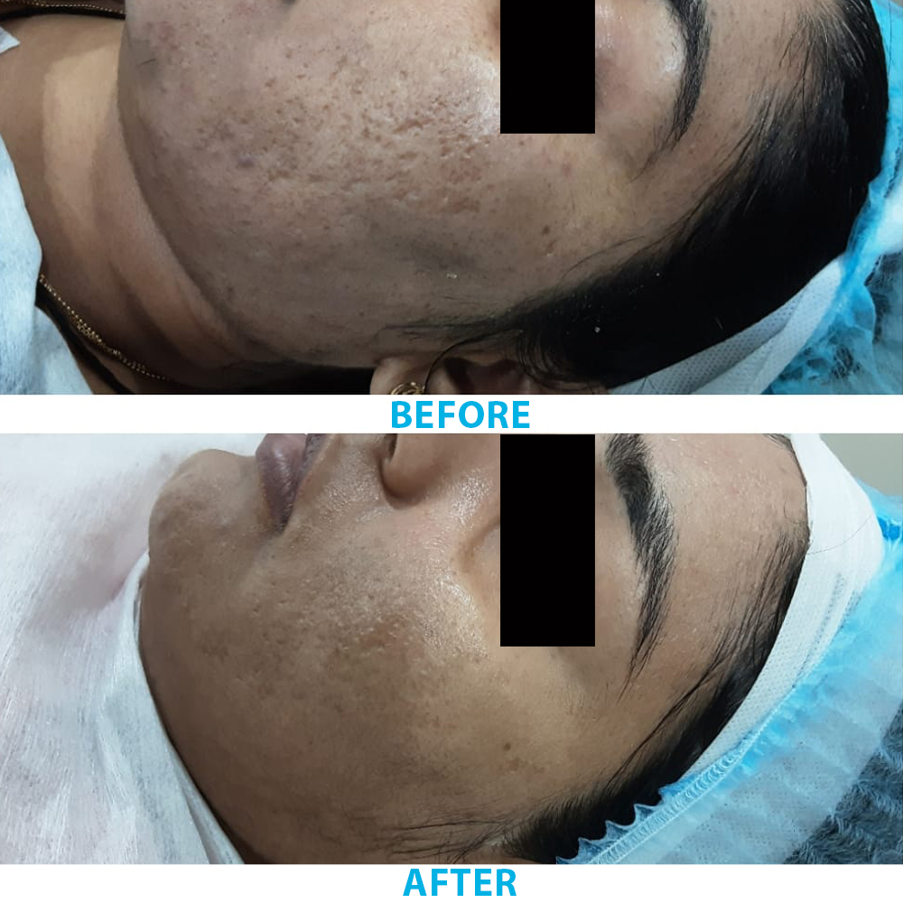 Microneedling For Acne Scars