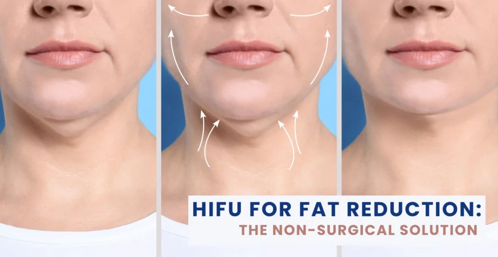 Deoxycholic Acid Injections The Non-Surgical Fat Reduction Solution