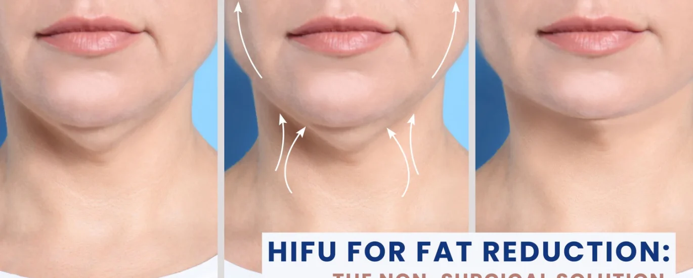 Deoxycholic Acid Injections The Non-Surgical Fat Reduction Solution