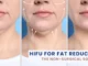 Deoxycholic Acid Injections The Non-Surgical Fat Reduction Solution