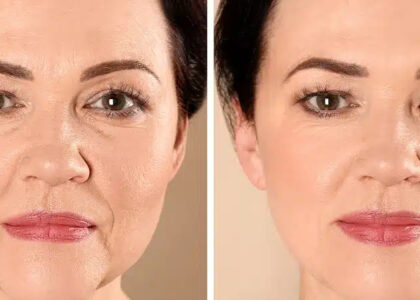 Top 3 Non-Surgical Treatments to Lift and Tighten Skin