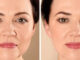 Top 3 Non-Surgical Treatments to Lift and Tighten Skin