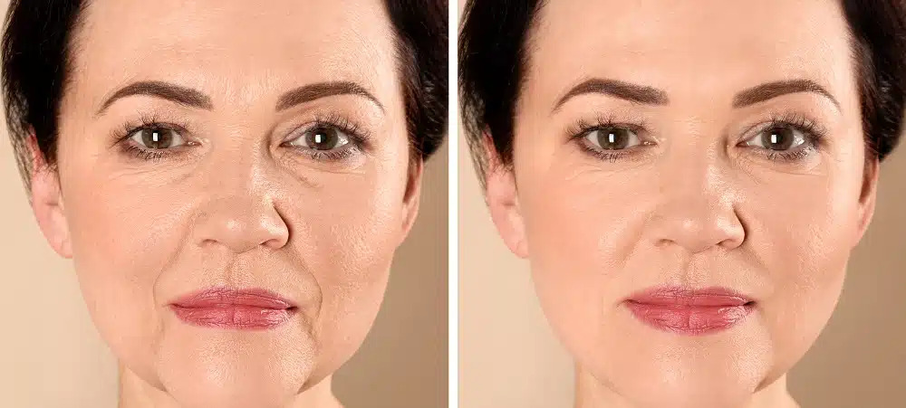 Top 3 Non-Surgical Treatments to Lift and Tighten Skin